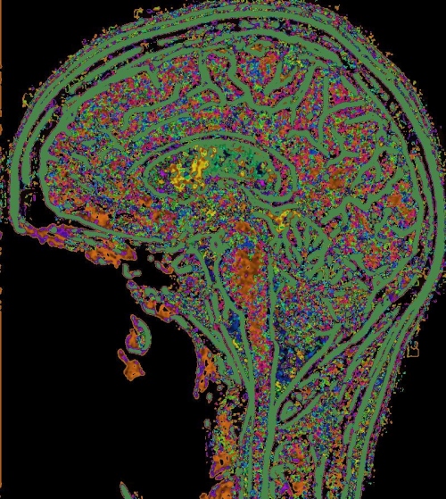 MRI_BRACES_W_02N_001_02.jpg